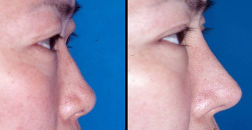 遼陽(yáng)市割雙眼皮哪家好？?jī)r(jià)格、技術(shù)、口碑全面解析！