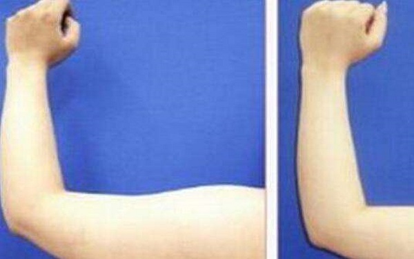 上瞼提肌手術(shù)的收費(fèi)是否昂貴？