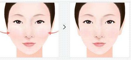 桂林有哪家醫(yī)院割雙眼皮好？