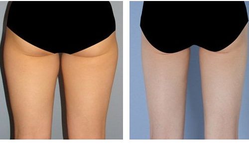 阿朵整容了嗎？揭秘明星整容真相！