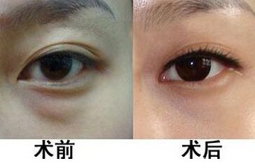 深圳哪家醫(yī)院的瓷貼面效果最好？