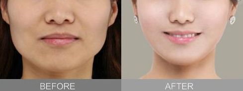 湖州下巴整容醫(yī)院哪家好？推薦湖州地區(qū)專業(yè)下巴整容醫(yī)院排行榜