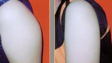 長(zhǎng)沙美容專(zhuān)家分析各種吸脂技術(shù)，用戶口碑持續(xù)贊譽(yù)