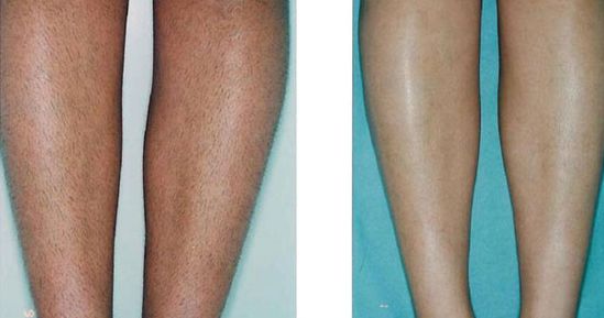 成都有哪些專業(yè)治療胎記的醫(yī)院？哪家醫(yī)院的治療效果好呢？