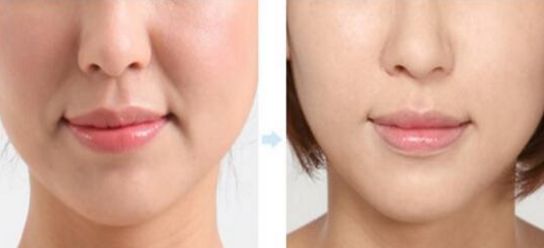 上海下頜角術(shù)醫(yī)院哪家專業(yè)可靠？