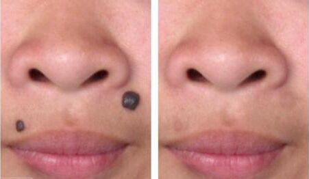 胎記是否可通過激光手術(shù)去除？激光去胎記的優(yōu)點(diǎn)有哪些？