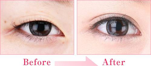 濟(jì)南哪家醫(yī)院做細(xì)胞填充鼻唇溝效果好？