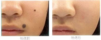 合肥祛斑醫(yī)院那家好？專家推薦的治療祛斑醫(yī)院大盤點