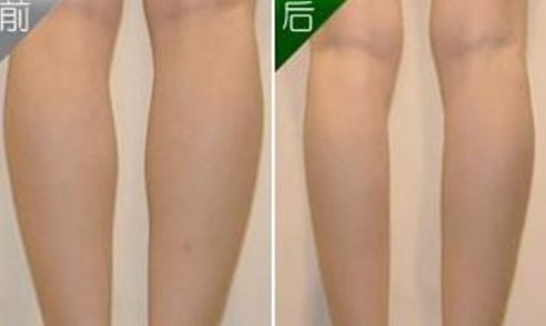 沈陽哪家醫(yī)院做眼角整形效果好且價格合理？