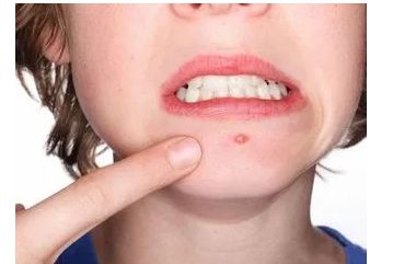 番禺區(qū)有優(yōu)質(zhì)整容醫(yī)院，熟練處理斑點與疤痕問題，并公開價目表