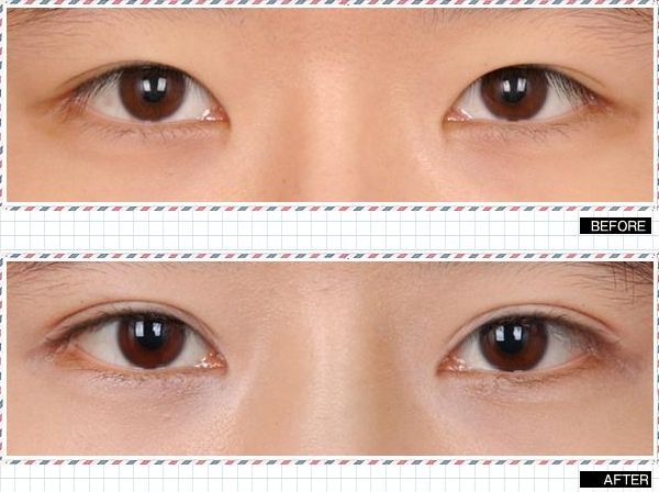 大連有哪些專業(yè)的祛眼袋醫(yī)院？從專業(yè)角度分析大連祛眼袋哪家醫(yī)院好