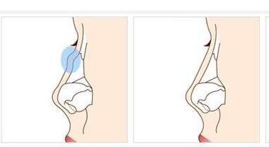 揚(yáng)州眼部手術(shù)中心：完美修復(fù)雙眼皮，經(jīng)典技術(shù)解決眼部問題