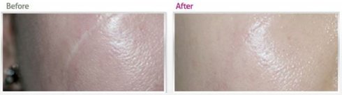 鐳射去痘印果真有效嗎？探尋去痘專家獨(dú)特秘籍！