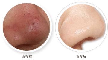 眼袋問題煩惱你？超聲波能治愈嗎？