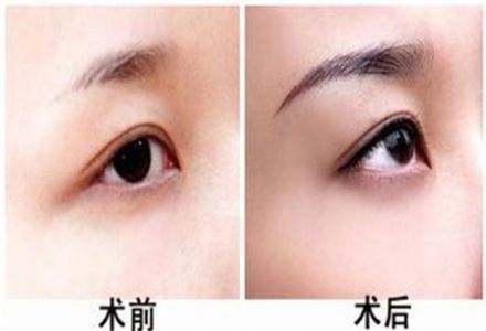 該癥狀是否需要修正？鼻子肥大修正的后果如何呢？