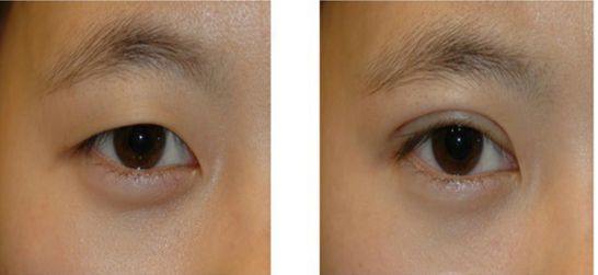 浙江省眼袋手術(shù)哪家醫(yī)院技術(shù)好，效果好，口碑好