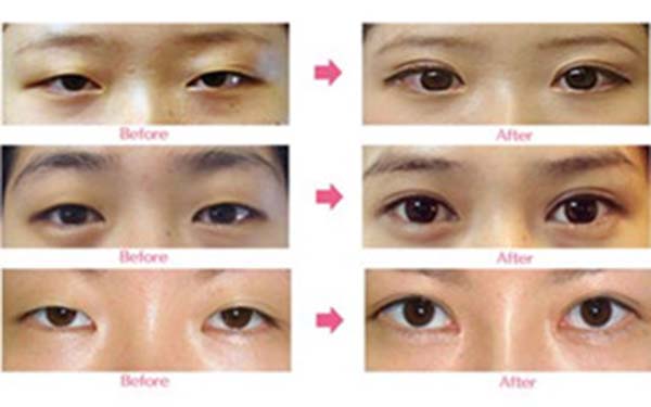 植發(fā)后是否需要特殊護(hù)理？