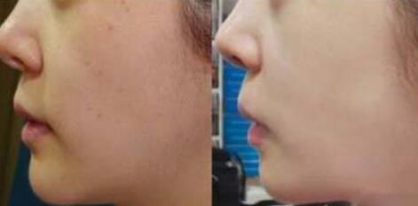 去除魚尾紋手術(shù)需要哪種方法？術(shù)后護理要點是什么？費用一般是多少？