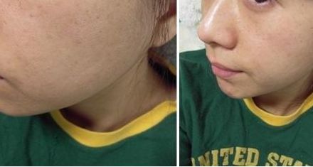 北京整形醫(yī)院吸脂效果怎么樣？