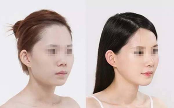 杭州2023年口碑好的保妥適去除抬頭紋整形醫(yī)院排行揭秘！