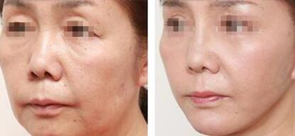 樸燦烈的容貌有了改變？整容傳聞是否屬實？