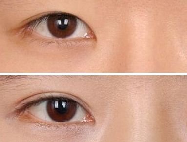 上海比較權(quán)威的去眼袋整形醫(yī)院推薦，專業(yè)選優(yōu)、信譽(yù)口碑集聚，公立私立任您挑選！