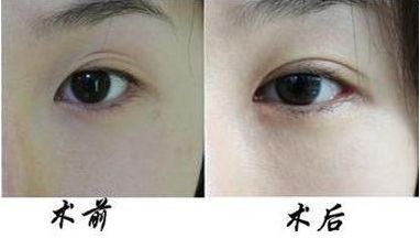 汕頭做光子嫩膚醫(yī)院哪家好？選擇最適合您的汕頭美容醫(yī)院