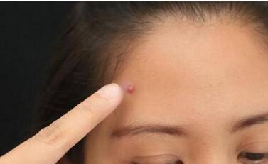 激光祛紅血絲真的有效嗎？祛紅血絲的價(jià)格大約是多少？