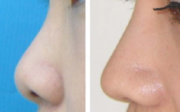 杭州重瞼術醫(yī)院2023前10強排行榜公布，切開法手術哪家好