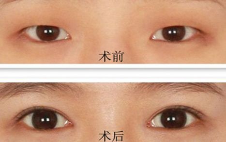 佛山整容醫(yī)院推薦專業(yè)縮胸手術(shù)服務(wù)