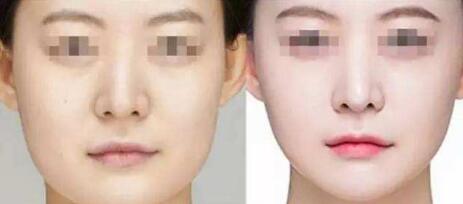 oe光子嫩膚到底值不值？價格合理嗎？