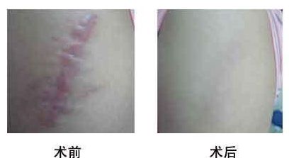 寧波去妊娠紋手術(shù)前10家醫(yī)院推薦！2023年光子整形醫(yī)院排行榜出爐！