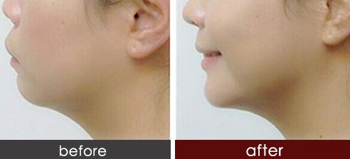 2023年浙江雙眼皮醫(yī)院排名榜出爐，哪家受歡迎？