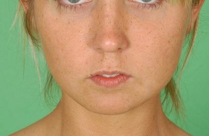 深圳哪家雙眼皮手術(shù)技術(shù)專業(yè)且效果好的美容醫(yī)院推薦