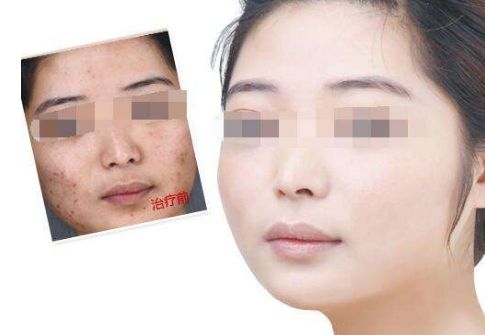 重慶雙眼皮術(shù)口碑極佳醫(yī)院， 塑造閃耀魅眼！