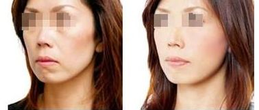 葫蘆島光學(xué)洗紋身醫(yī)院口碑排名TOP10大揭秘！