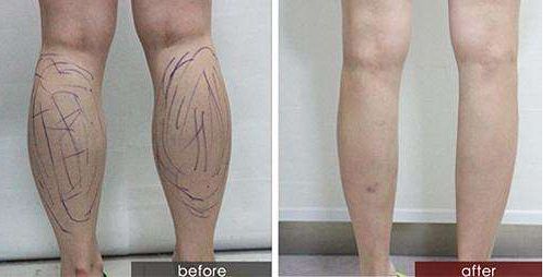 咸陽治生長紋玻尿酸注射哪個醫(yī)院好？口碑評價大揭秘