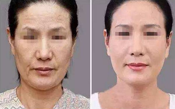 武漢頸部皺紋微針填充醫(yī)院排名及口碑評(píng)價(jià)TOP10盤點(diǎn)！