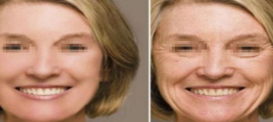 武漢注射豐唇玻尿酸哪家醫(yī)院好？排名前10強揭秘！