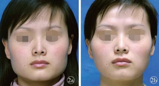 煙臺眼部微針祛皺醫(yī)院排名前10！