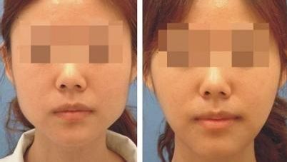 華西李正勇隆鼻手術(shù)效果如何評(píng)價(jià)？