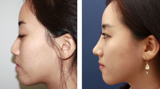 重慶面部皺紋填充前十正規(guī)醫(yī)院推薦