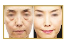 柳州靜態(tài)紋激光祛除，專家推薦的醫(yī)療整形醫(yī)院排名前10