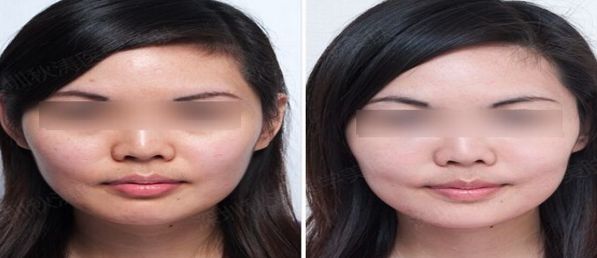 天津最佳凹陷疤痕修復(fù)整形醫(yī)院排行榜及評(píng)價(jià)