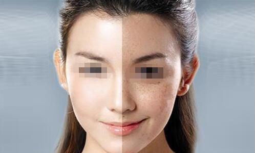 上海麗妍盛美隆鼻真的有效嗎