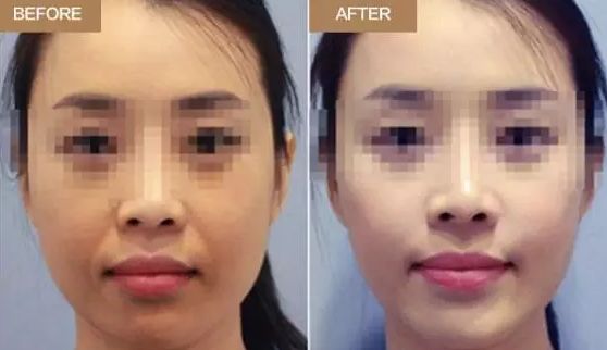 濟(jì)南微整形川字紋口碑排名前10醫(yī)療美容醫(yī)院大揭秘！