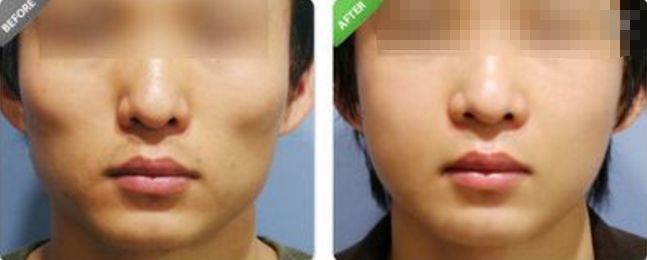 了解有效而安全的方式，改善鼻型：隆鼻術(shù)前考慮及手術(shù)后常見問題—全面指南