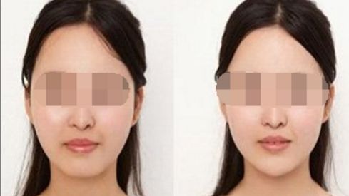 湖南黃金微雕去皺排名前10醫(yī)院大揭秘！