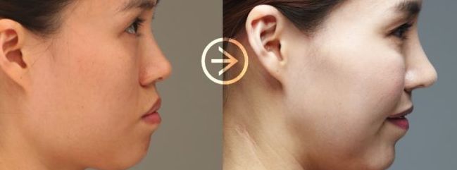 中山眼瞼凹陷填充正規(guī)醫(yī)院排行榜：十佳機(jī)構(gòu)效果點(diǎn)評(píng)