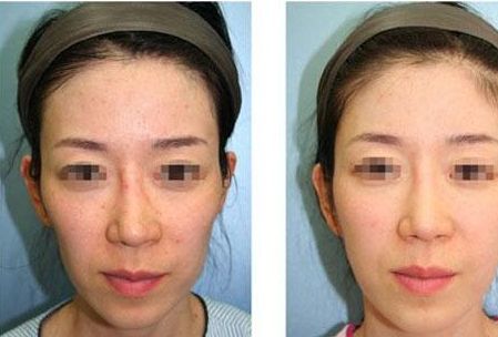 八大處整形美容價(jià)目表2023更新！名醫(yī)咨詢+隆鼻前后效果對(duì)比詳解